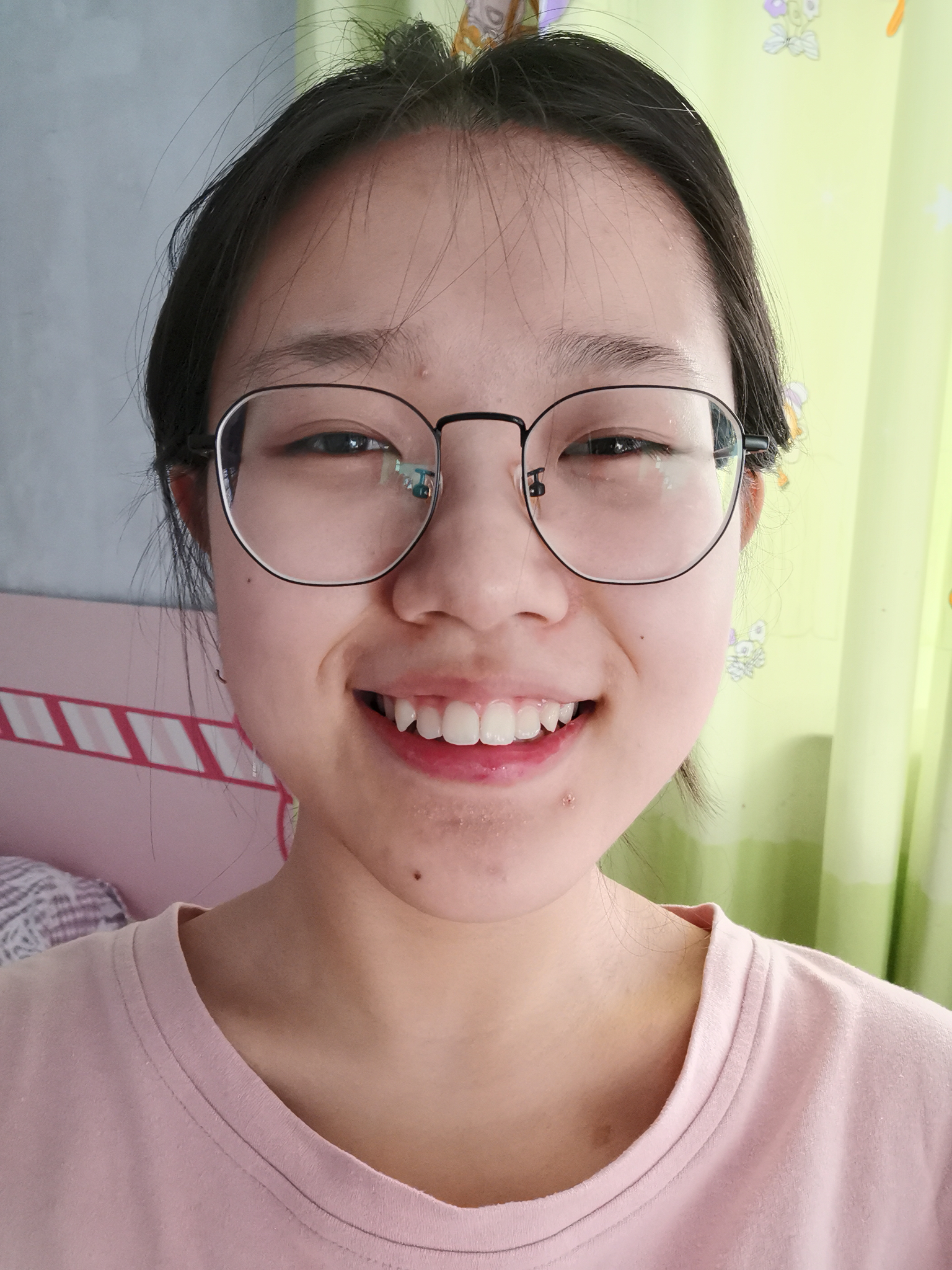 上嘴唇上翘,上翻怎么办?侧面看起来简直丑哭我!