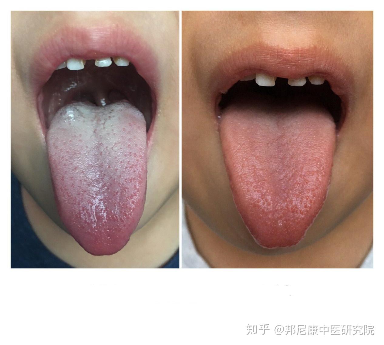 教你看舌苔，六种情况帮你分辨体质 - 知乎