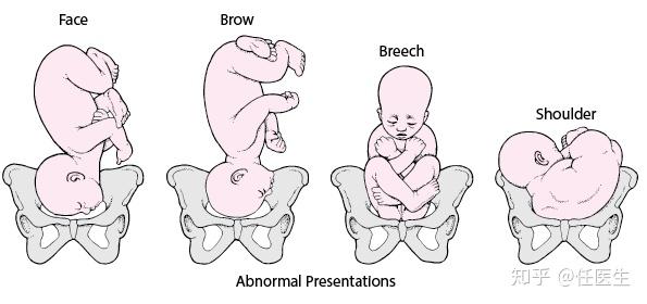 36周孕晚期胎位为臀位能顺产吗? - 知乎