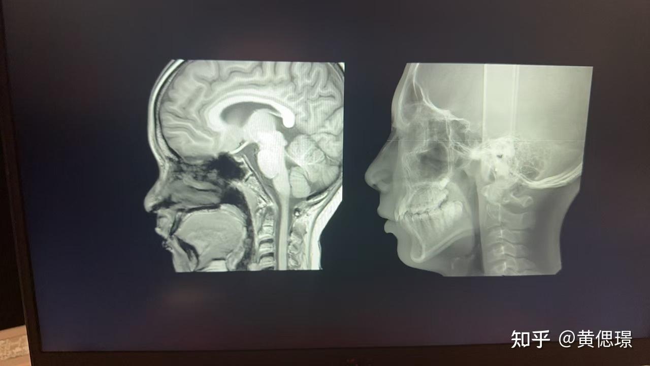 如何看懂颞下颌关节磁共振影像?