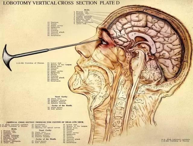 某些情况甚至不需要手术室就可以施行弗里曼为了推广他的冰锥疗法,还