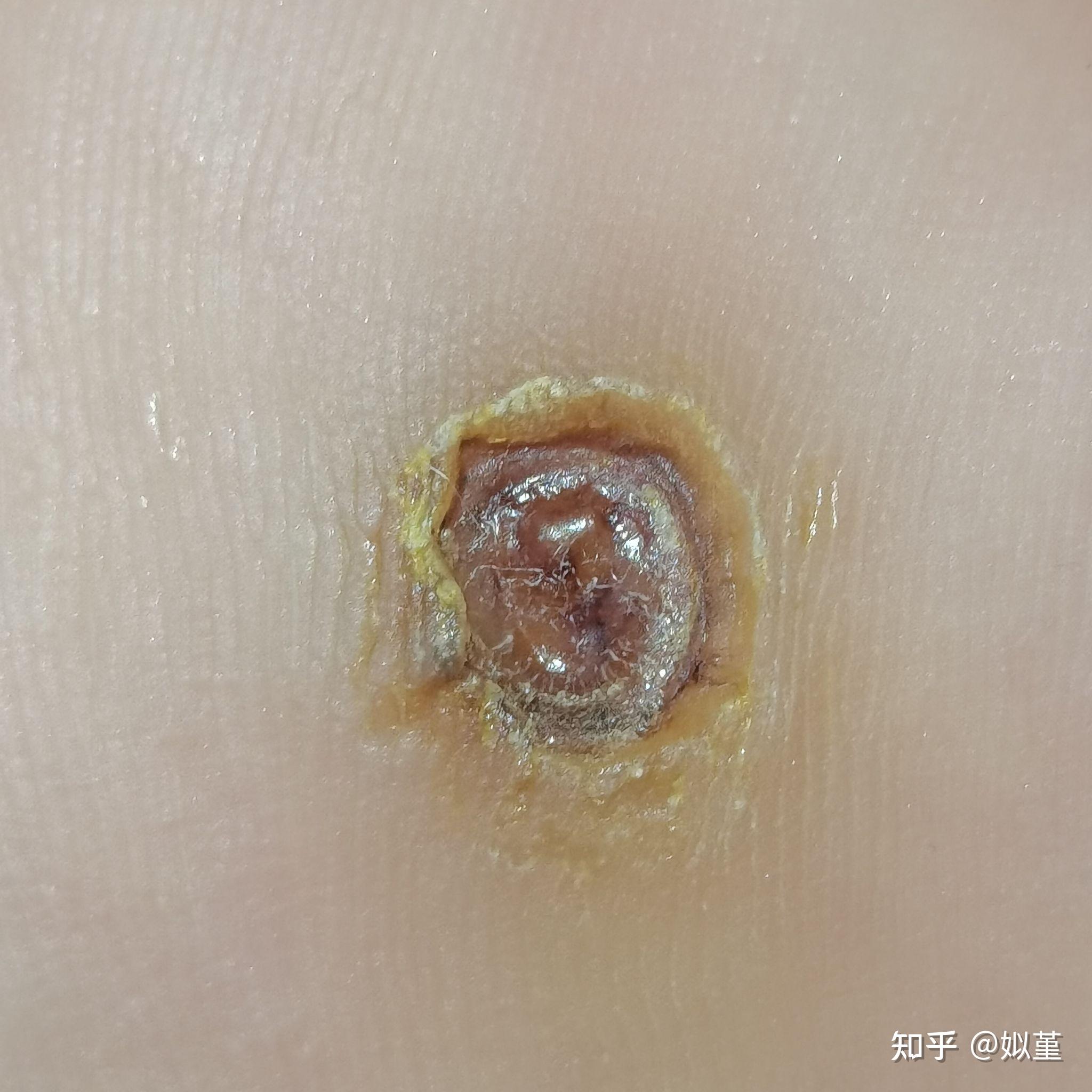 跖疣激光恢复日记