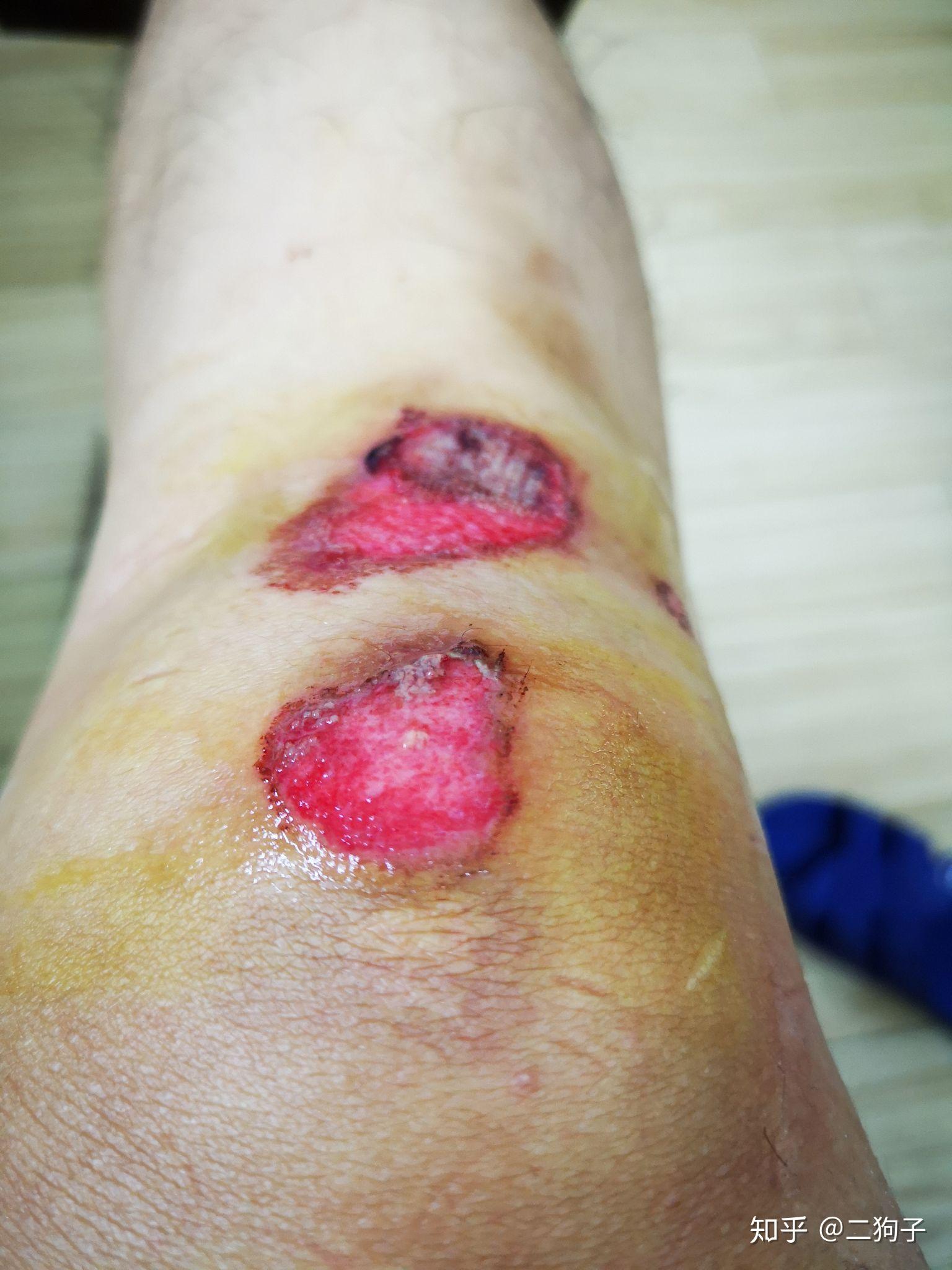 膝盖摔伤后蹲着上厕所是一种怎样的体验