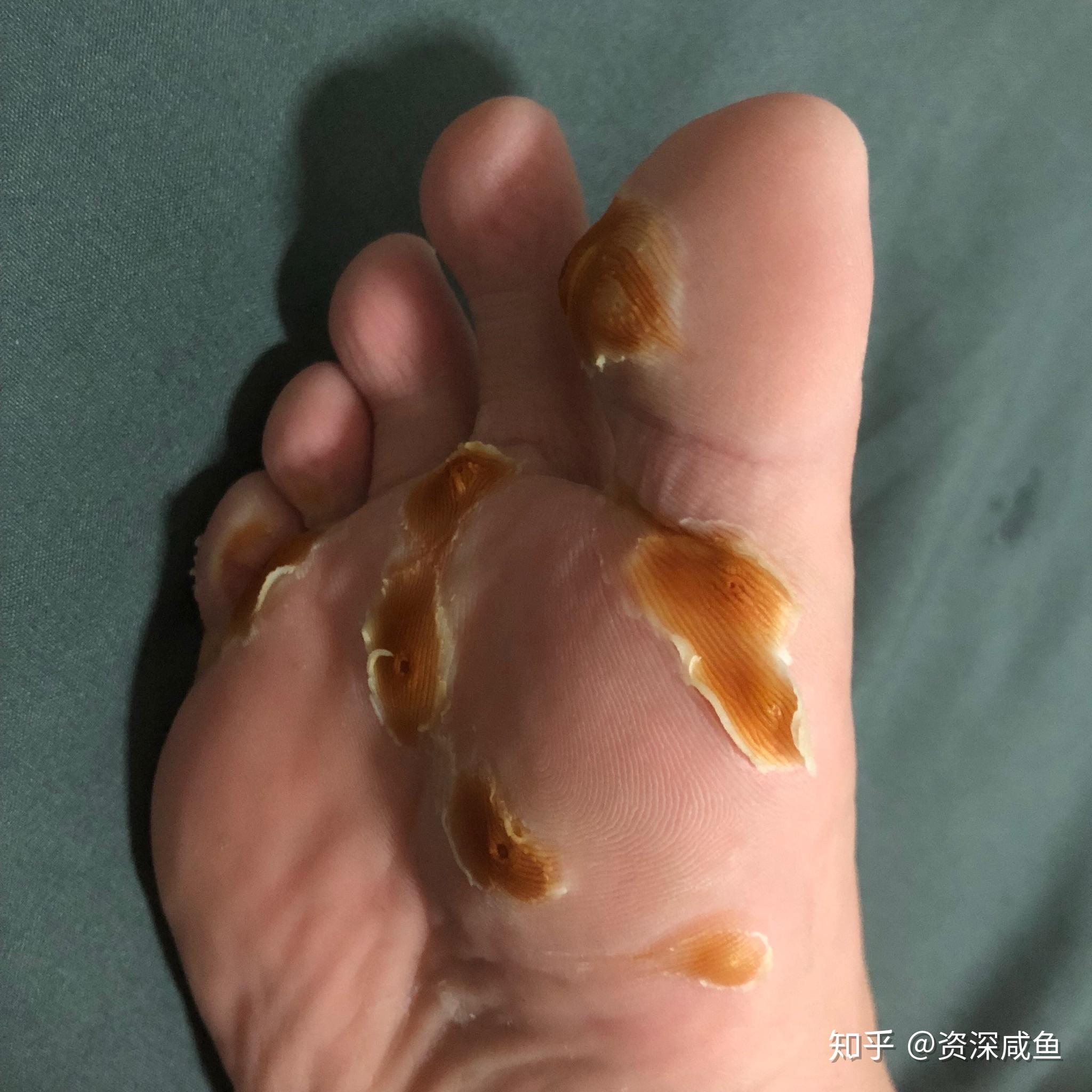 喝了兩個星期的中藥終於把9顆蹠疣消滅了