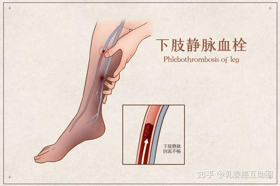 脚血管堵塞怎么治疗图片