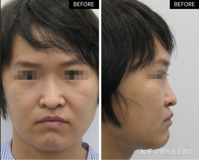 泪沟,鼻基底凹陷怎么改善?老路列举真实案例进行讲解 - 知乎