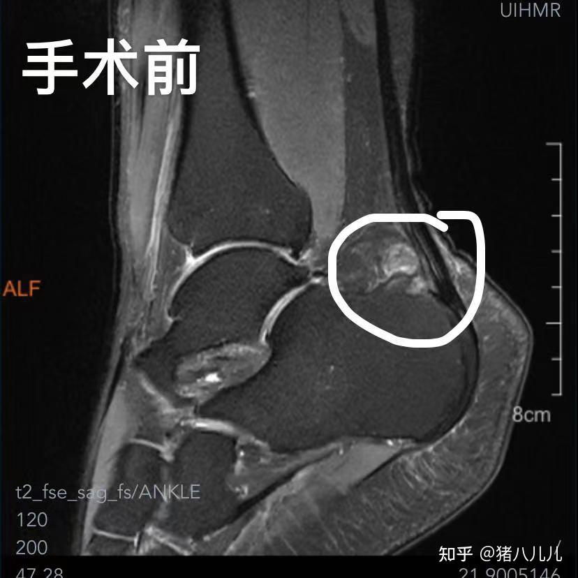 记录haglund畸形综合征(跟腱炎)手术治疗