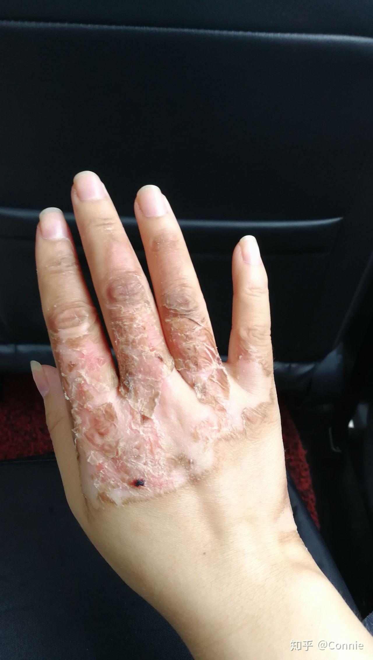 手被开水烫伤了怎么办