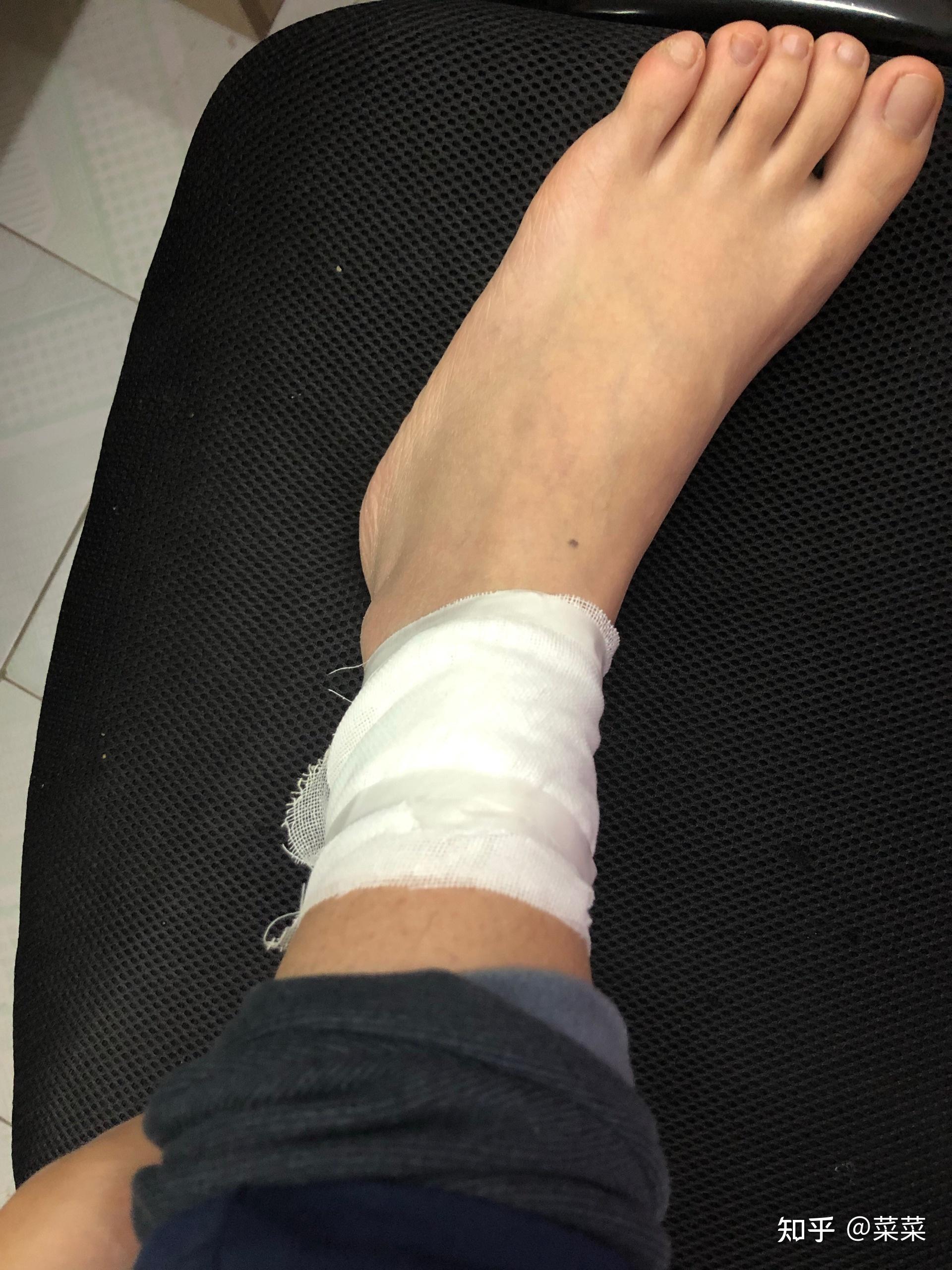 热水袋低温烫伤千万要注意