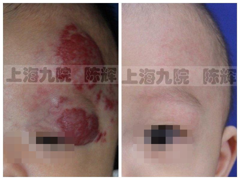 血管瘤治疗方法的优劣和选择(多图详解) - 知乎