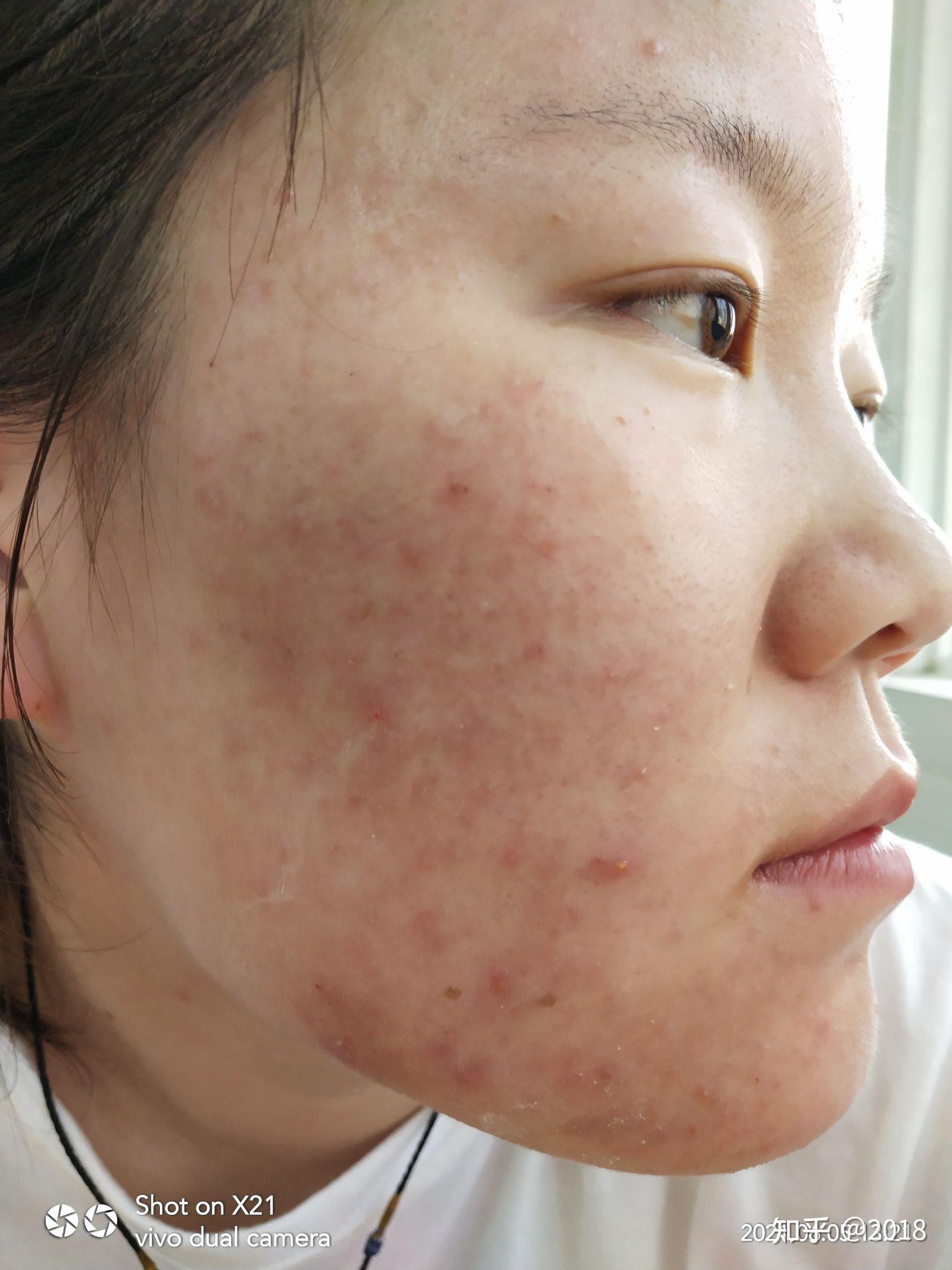 作为一个青春期的学生,满脸痘痘一直苦恼着我,如何轻松祛痘? - 知乎