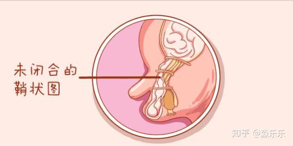 右侧鞘膜积液怎么办告诉你治疗方法