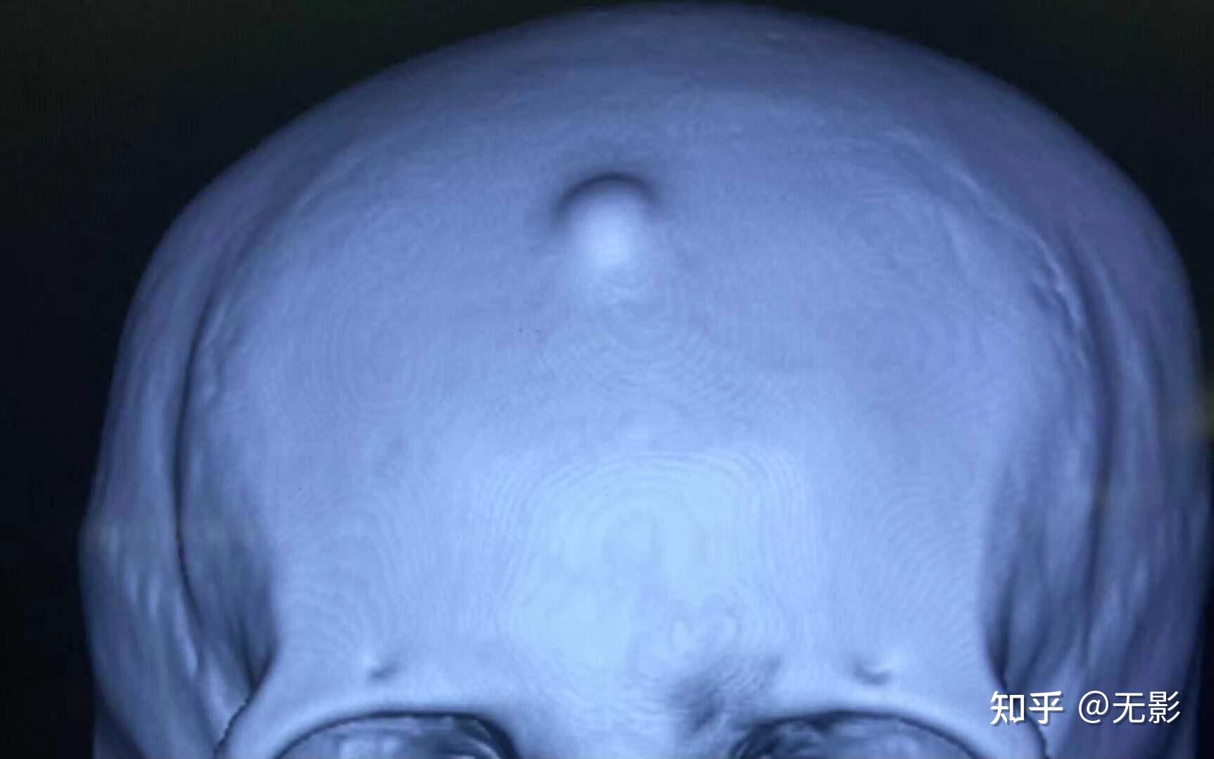 手术叙事61骨瘤