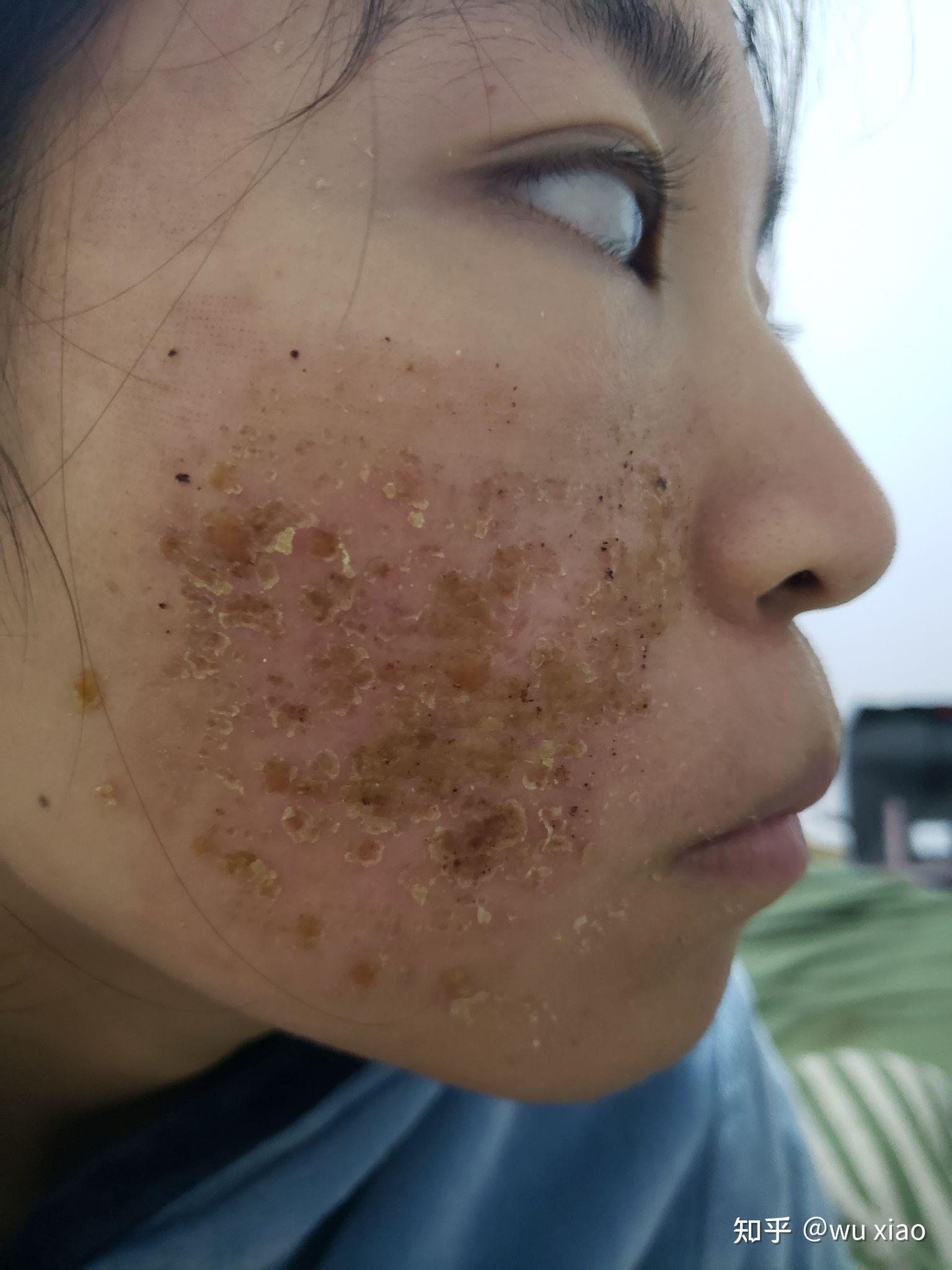 点阵激光祛痘坑是什么样的体验