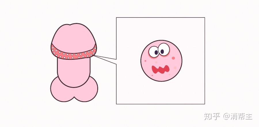 健康科普丨jj长了小疙瘩是不是得了性病