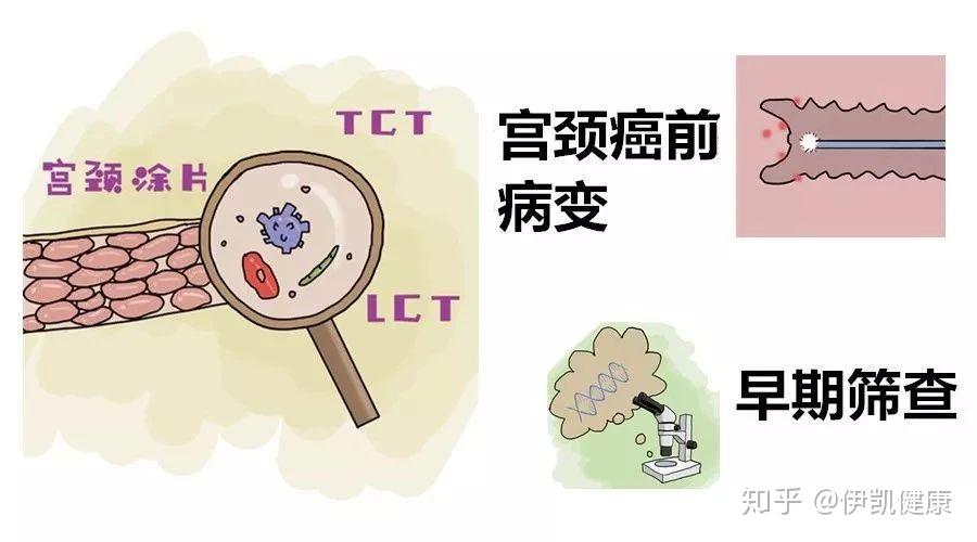 晚期患者,因癌組織壞死伴感染,可有大量米湯樣或膿性惡臭白帶.