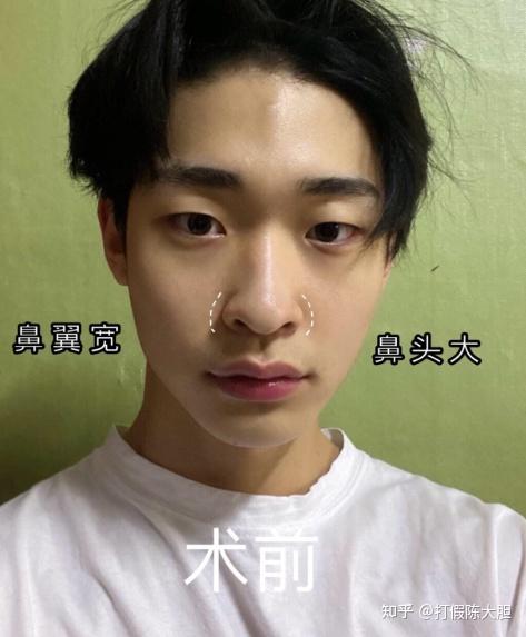 鼻,额部的落差大,链接不流畅,鼻背的线条曲折,有驼峰,鼻头大并且凸出