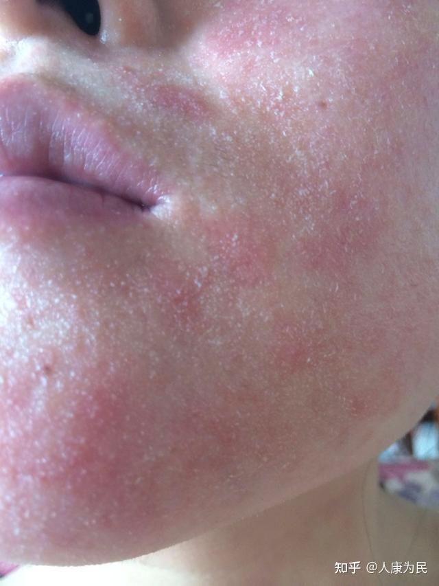 7大常见的皮疹问题:类型,原因,治疗方法 - 知乎