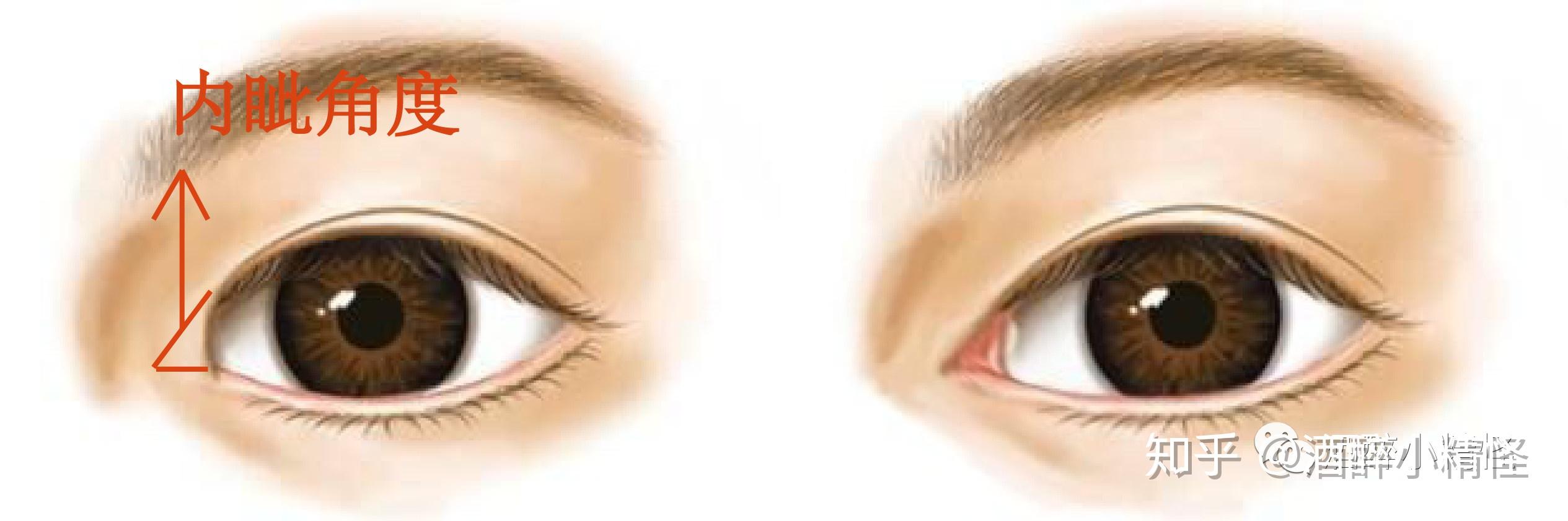 3种内眼角形状，你最适合哪种？ 内眦赘皮不仅影响_圈子-新氧美容整形