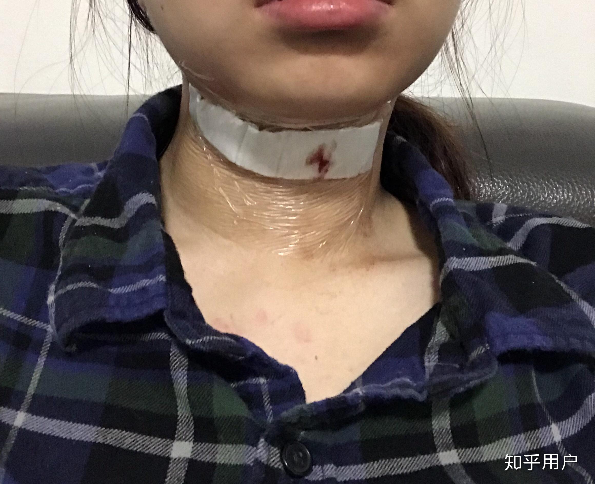 甲狀腺舌骨囊腫一定要手術嗎