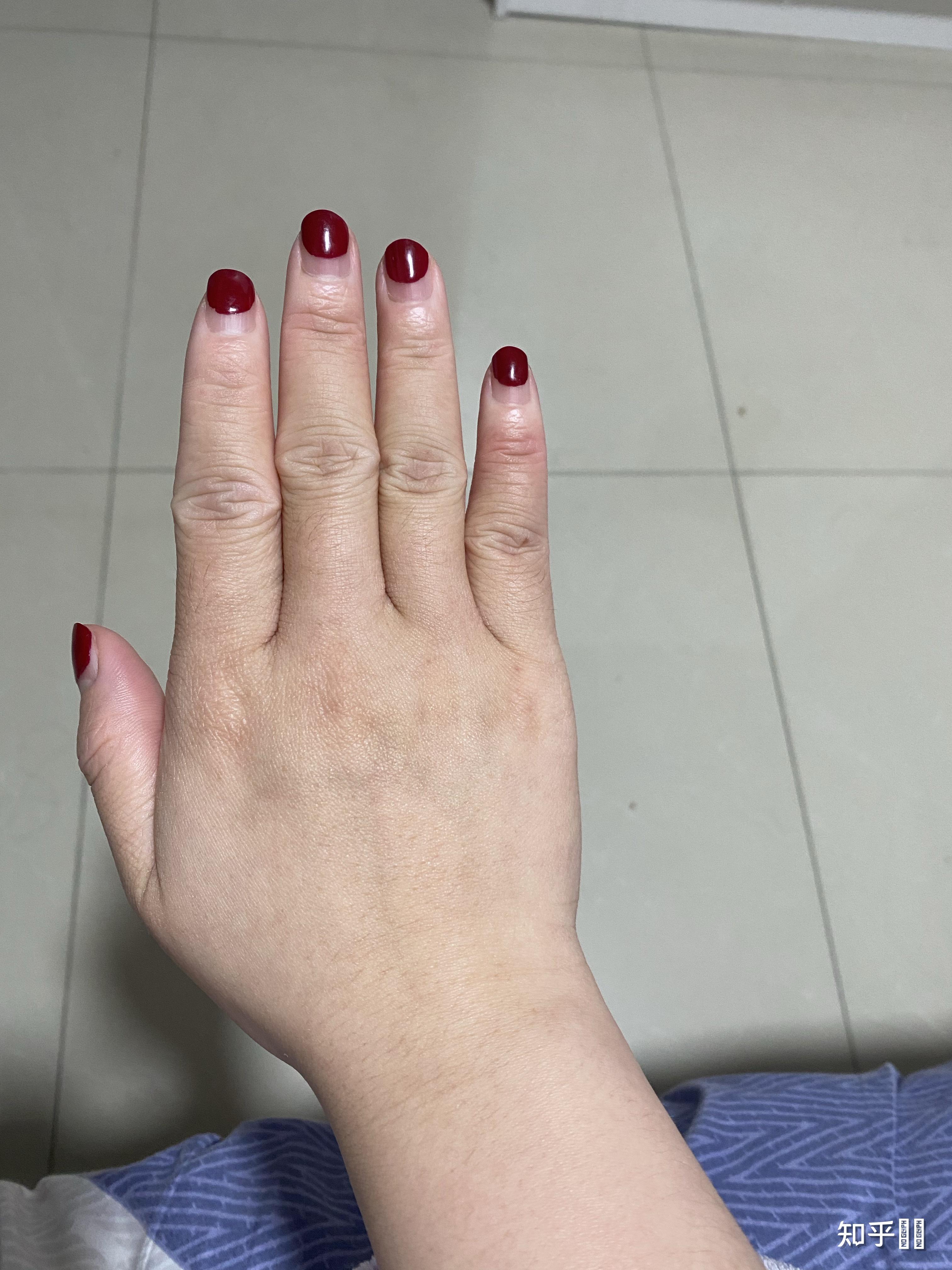 年纪轻轻23岁手上皮肤就很干有很多皱纹,像老年人干瘪的手,怎么办呀?