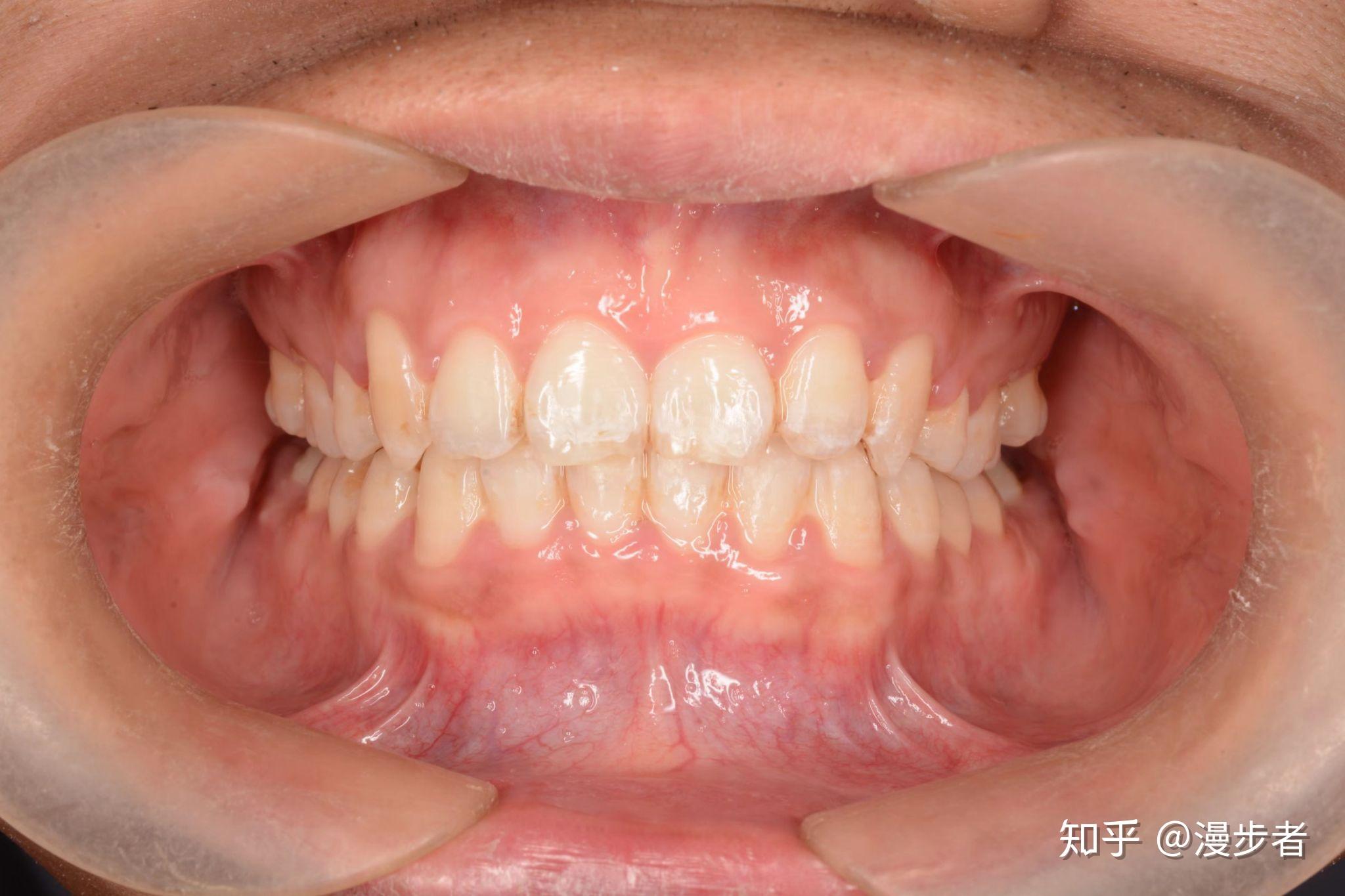 太原牙齿矫正于立涛：上颌锁颌、下颌唇倾正畸案例详解 - 知乎