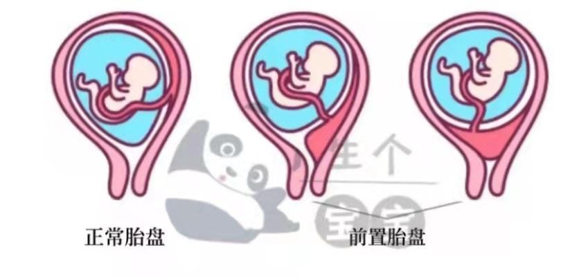 胎盘低置怎么办? - 知乎