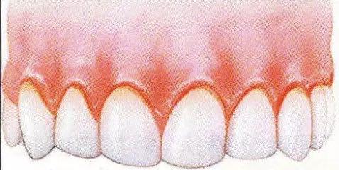 时游离龈和龈乳头变为深红或暗红色,这是由于牙龈结缔组织内血管充血