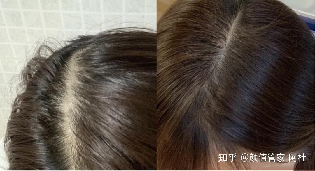 植发技术现在发达吗知乎(现在植发技术发展到什么程度了)