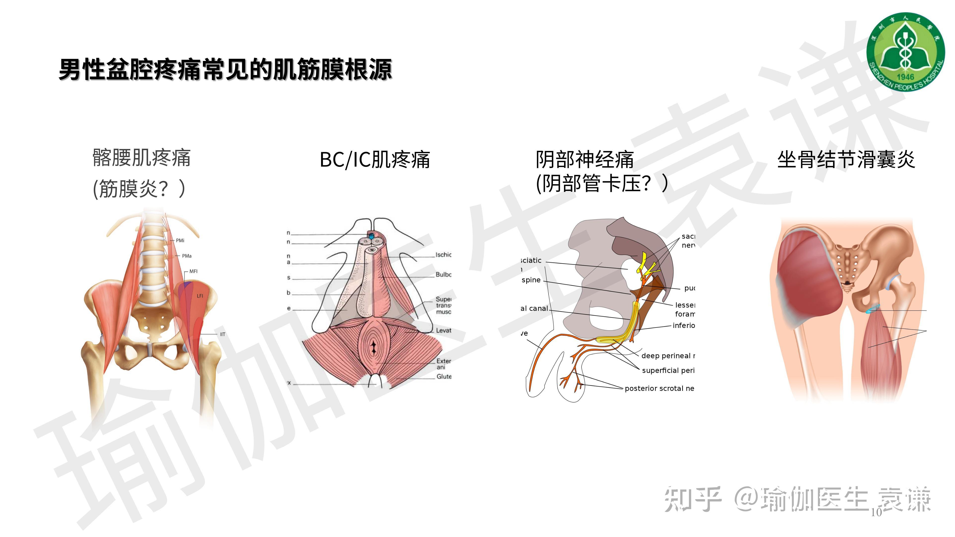 男性盆腔疼痛的肌筋膜根源