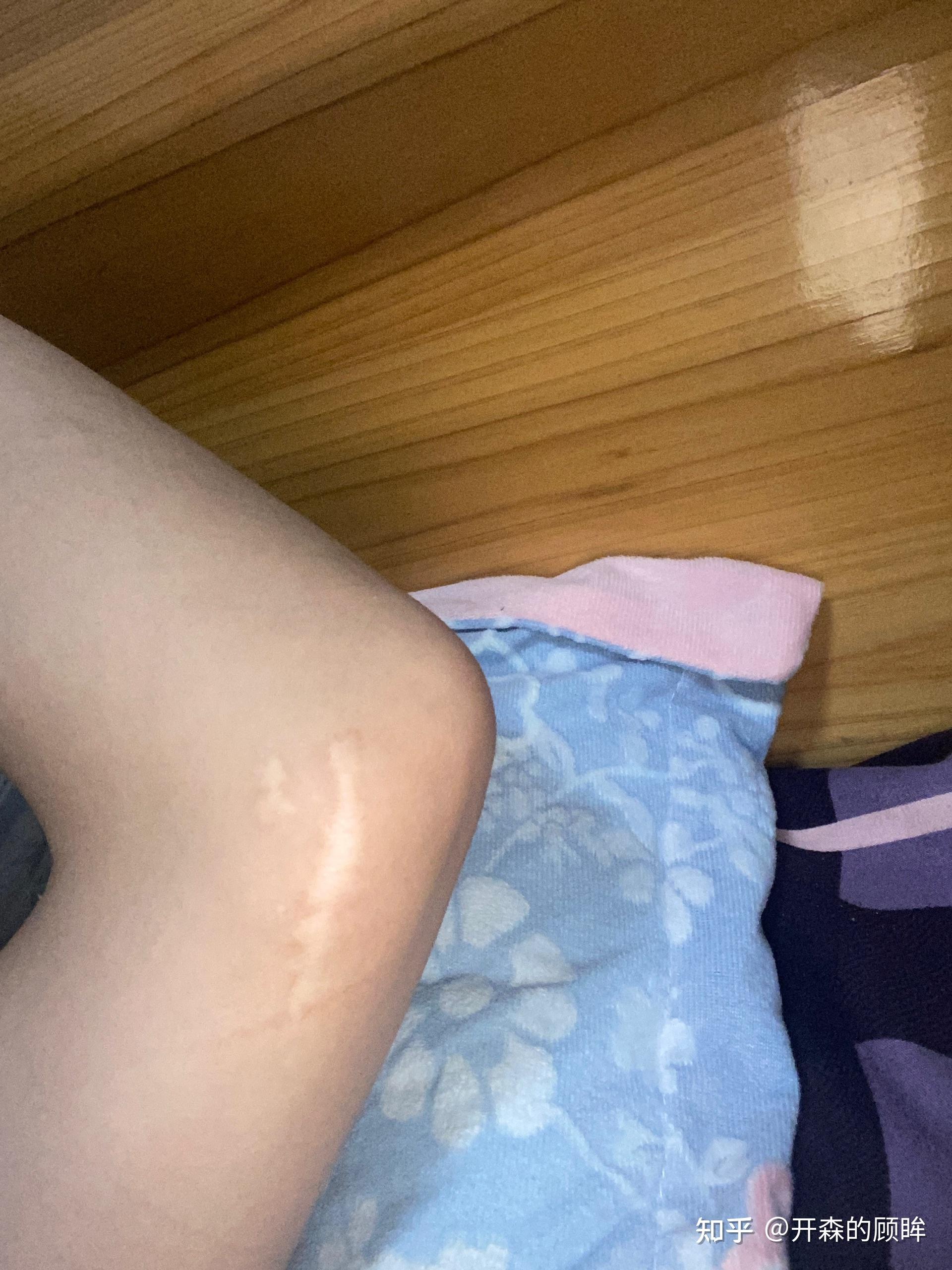 手肘上有个疤能去当兵吗 - 知乎