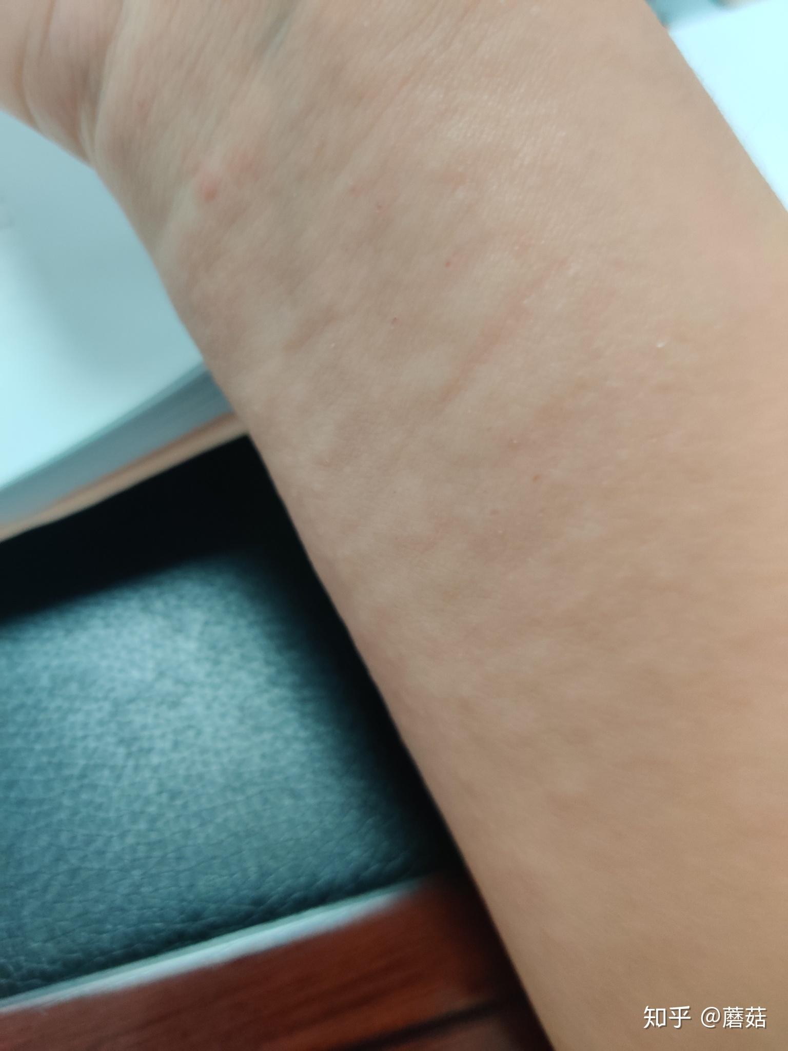 吃药腿上就长密集的小红点 ,能查出过敏源吗? - 知乎