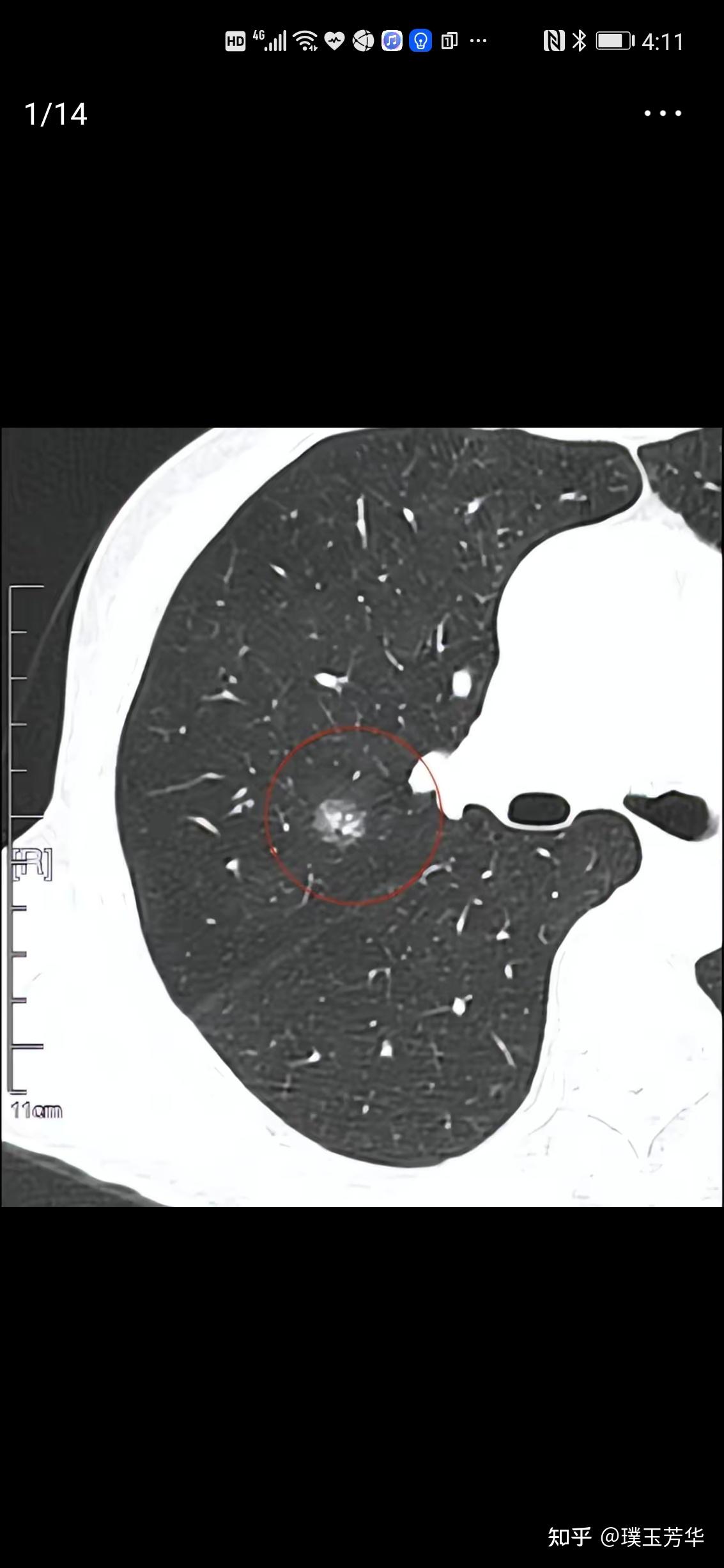 有微乳头亚型和气腔播散,1cm的混合磨玻璃肺结节也可以来者不善