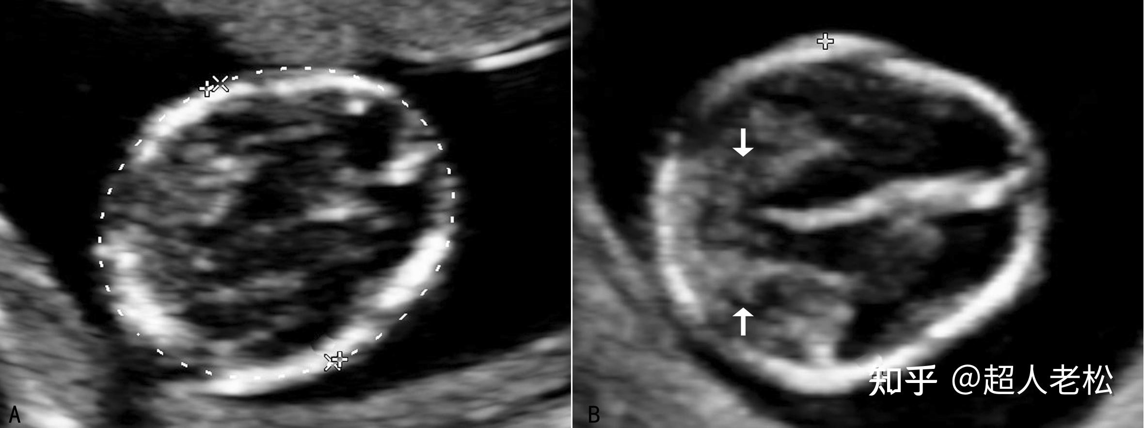 明明白白做超声24-9：中孕期胎儿染色体异常-颈部异常 - 知乎