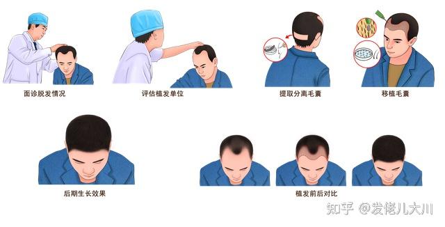 植发过程图图片