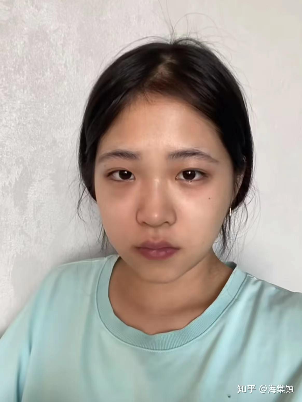 22岁,脸部状态差,浮肿虚胖,没钱做医美怎么办?