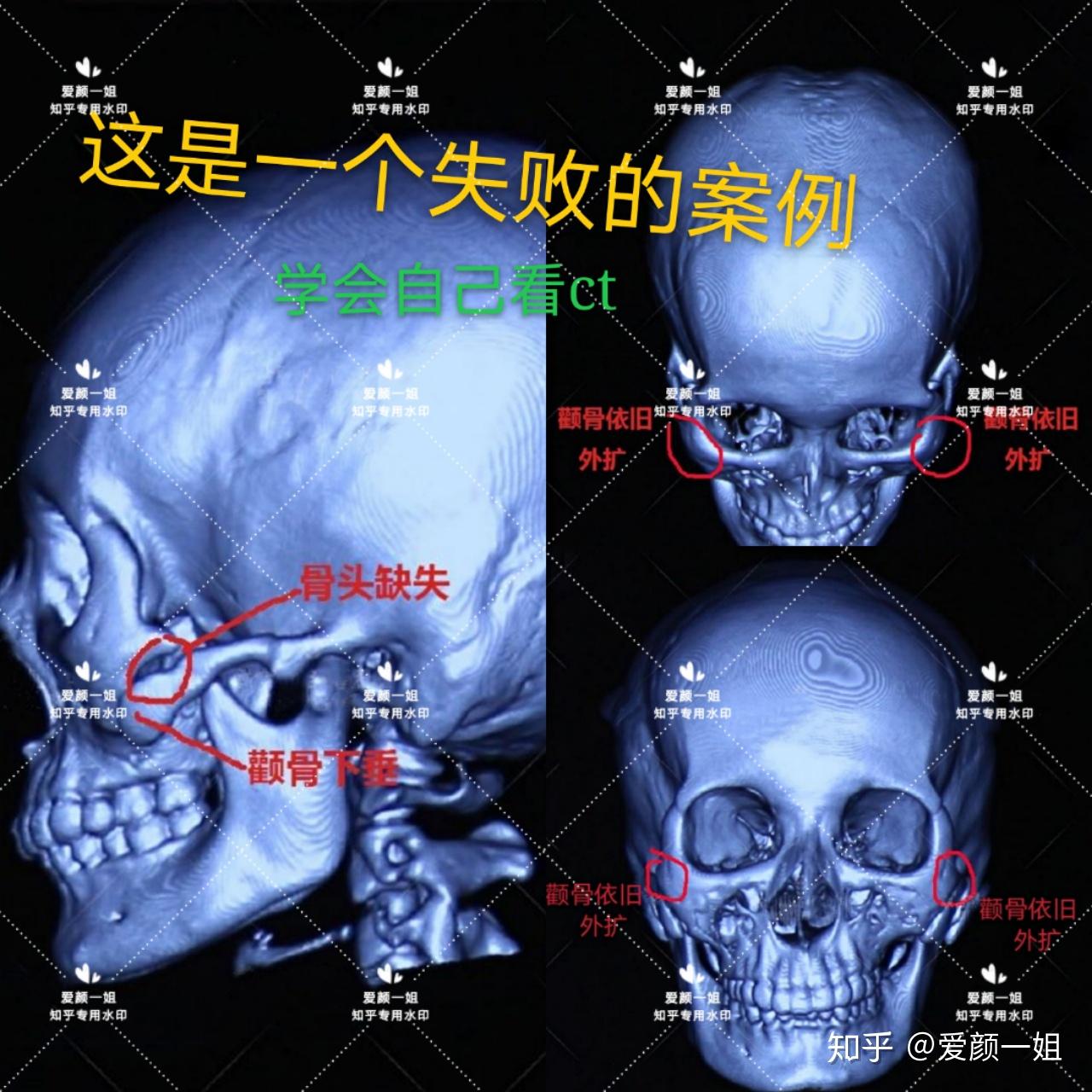 个性化3D定制重建颧骨颧弓手术临床案例分析 - 知乎
