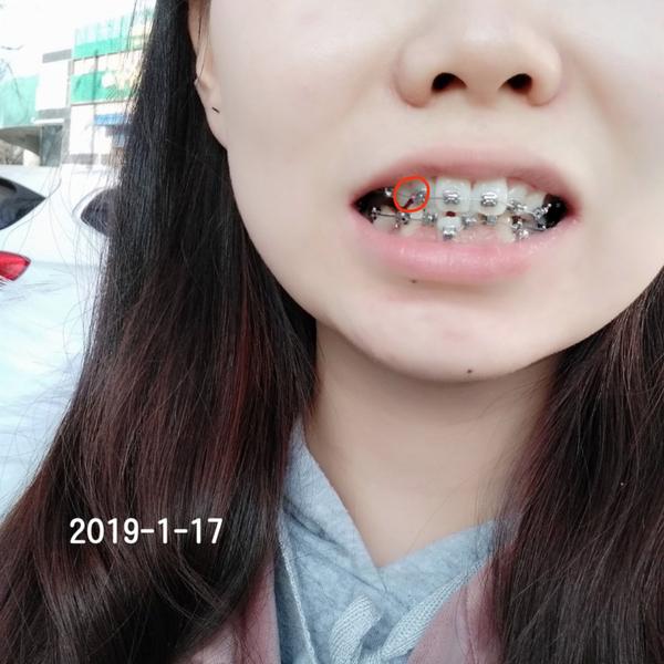 因带牙套牙龈变成这样正常吗?