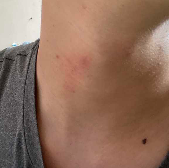 怎么在三小时内消除吻痕? - 知乎