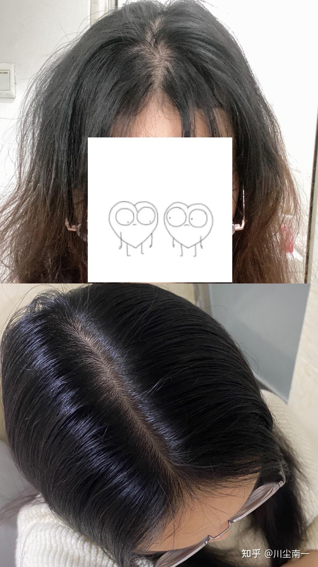 女生 发量少 头顶快秃了 有没有什么好的生发方法!跪求! - 知乎