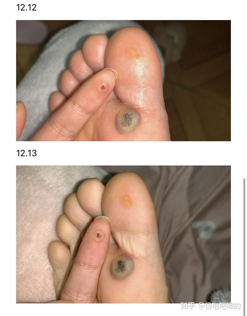 液氮冷冻跖疣记录 - 知乎