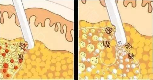 抽脂肪对身体有害吗?抽脂有什么风险和后遗症?