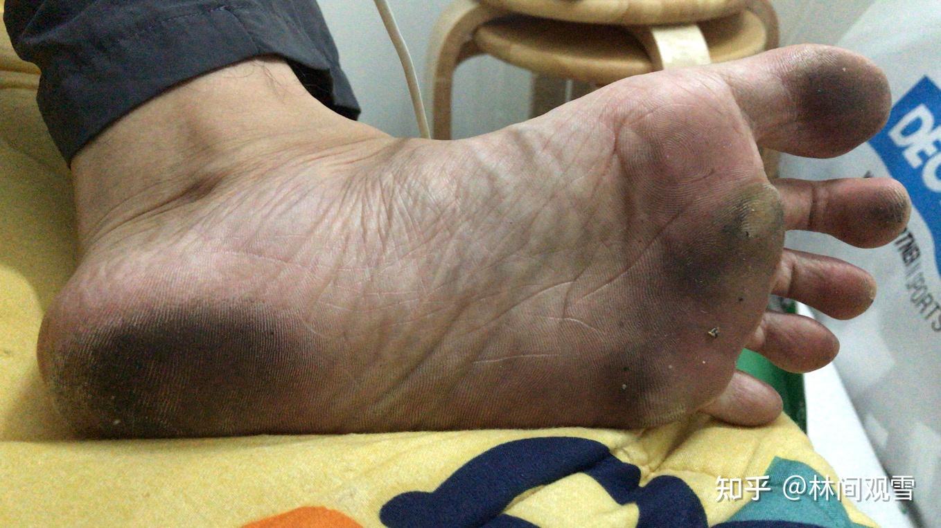赤脚跑步跑出一脚老茧是什么样的体验
