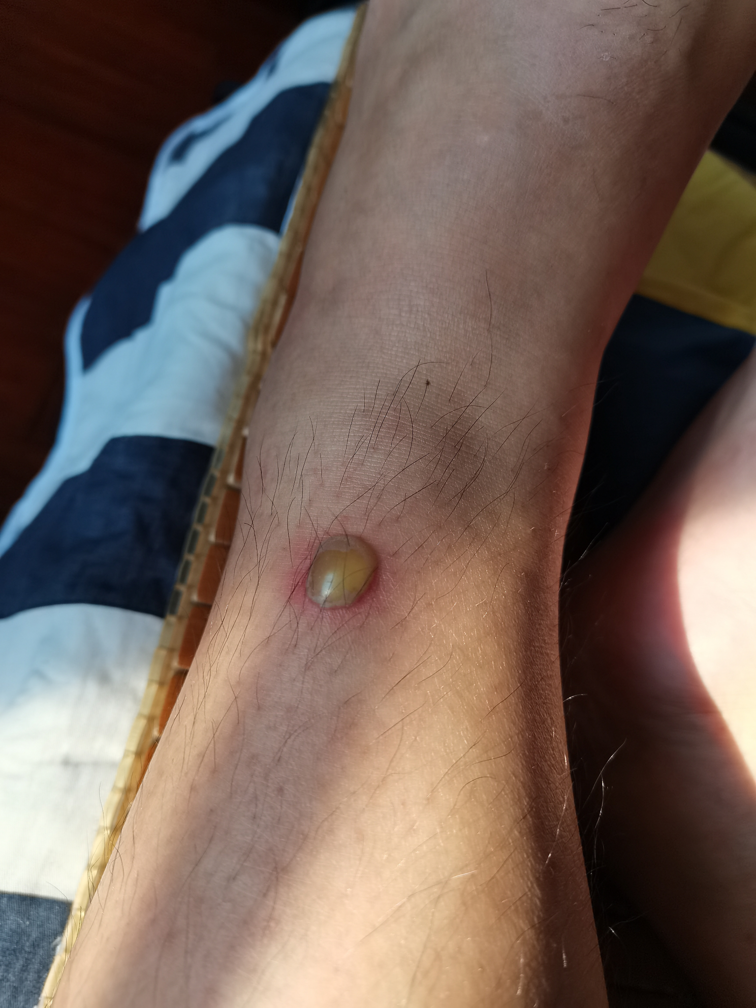 腿上出现了一个脓包