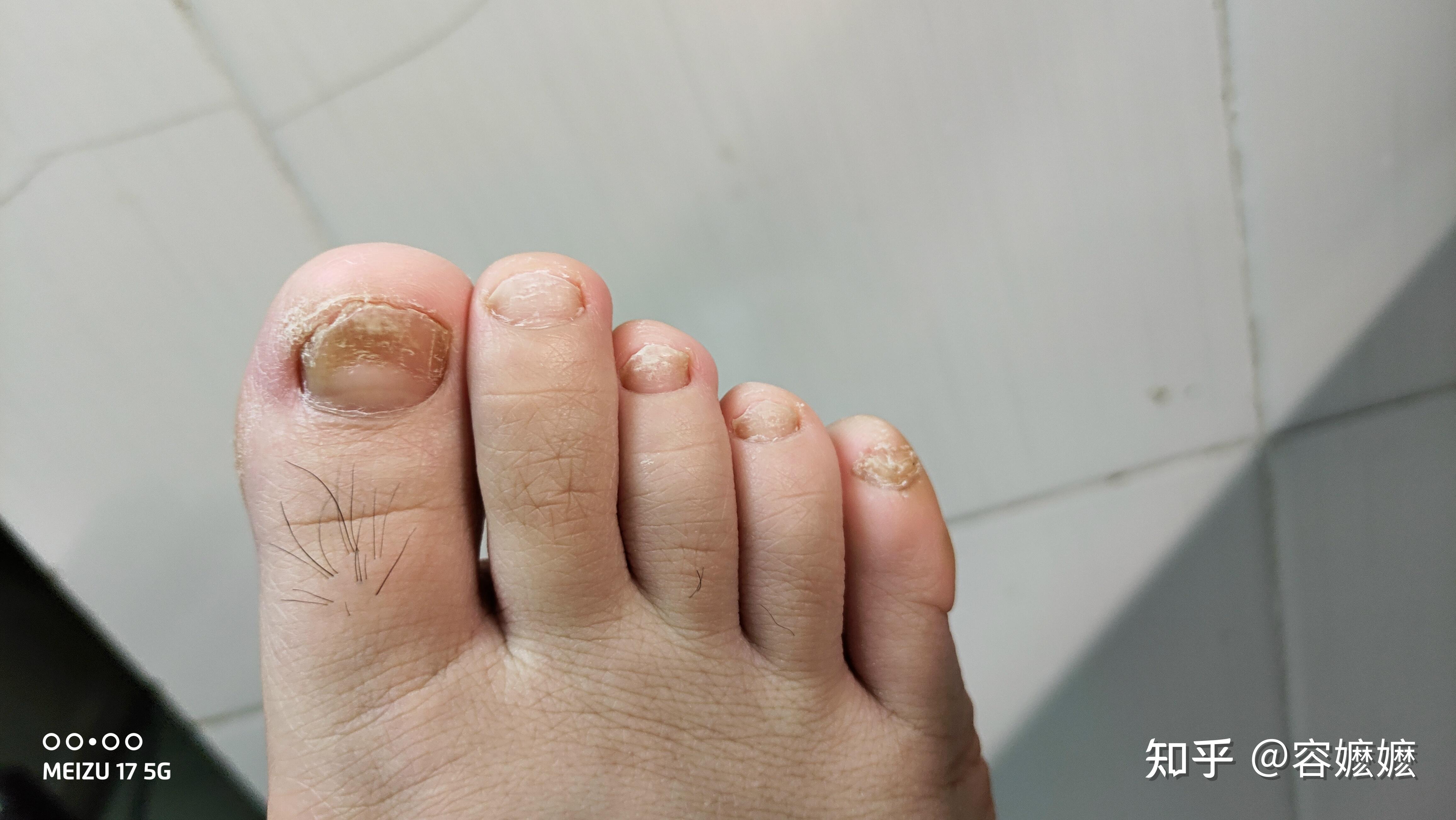 女生得了灰指甲怎么办? - 知乎