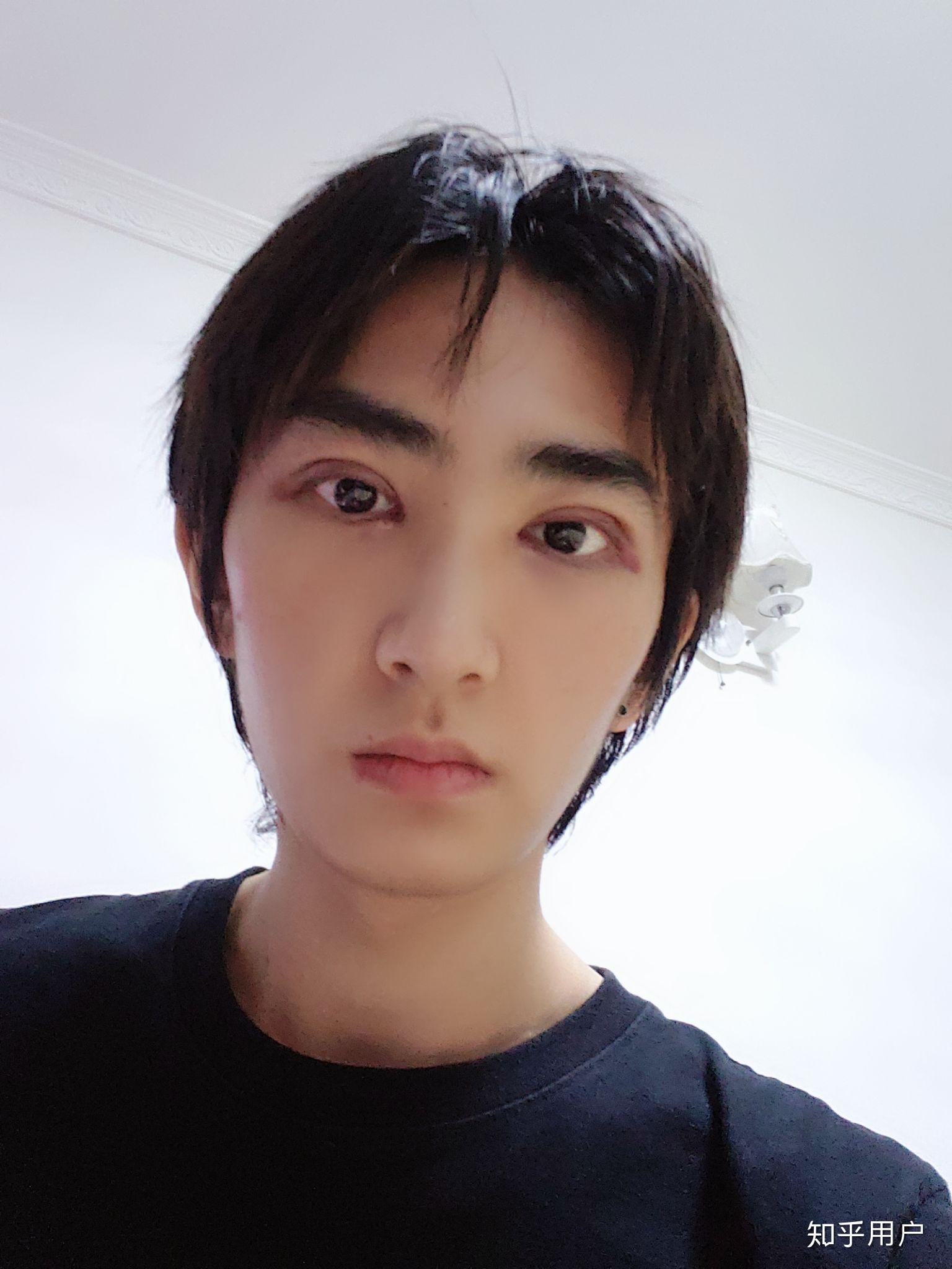 男生做双眼皮手术是什么体验