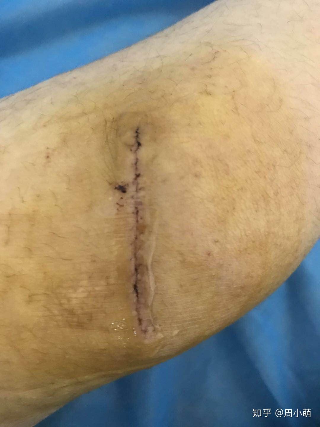 膝盖疤痕切除手术