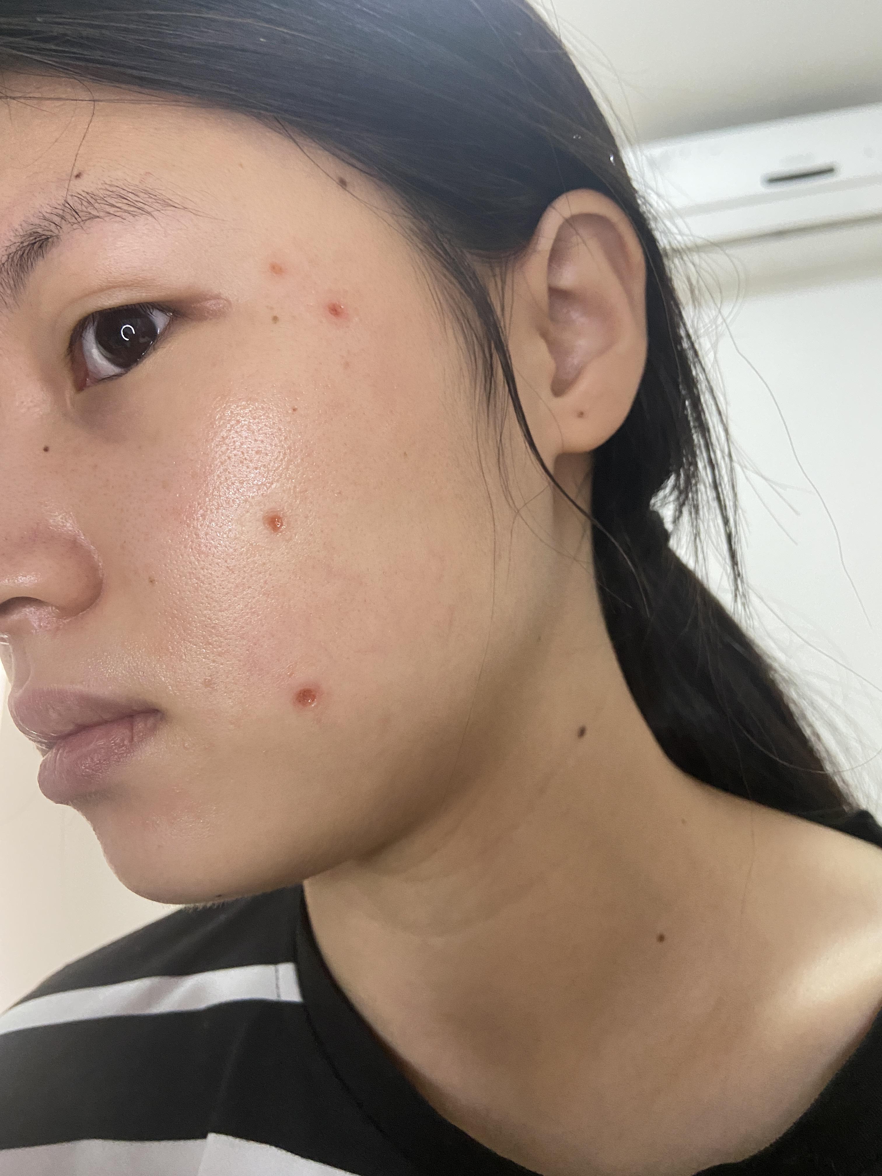 激光点痣第6天这样正常吗