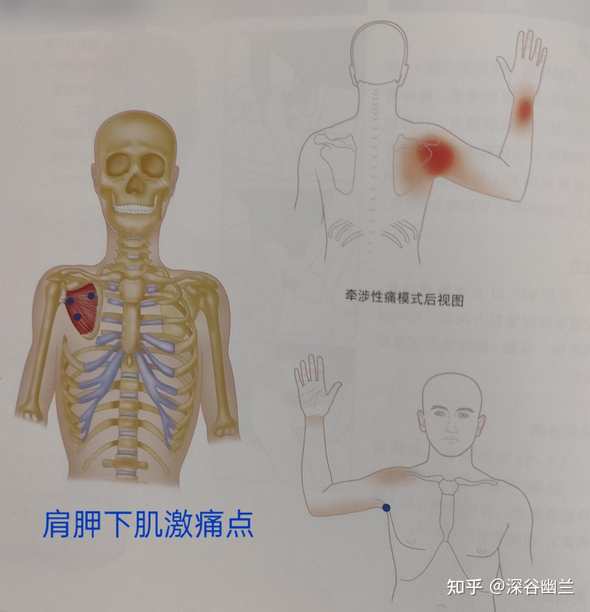 背阔肌腋窝激痛点牵涉痛是肩胛骨下角5～10厘米部位的疼痛