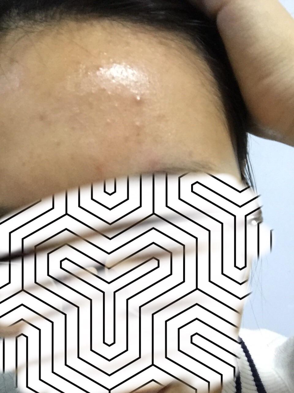 闭口 小痘痘 痤疮性丙酸杆菌? - 花伞的回答 - 知